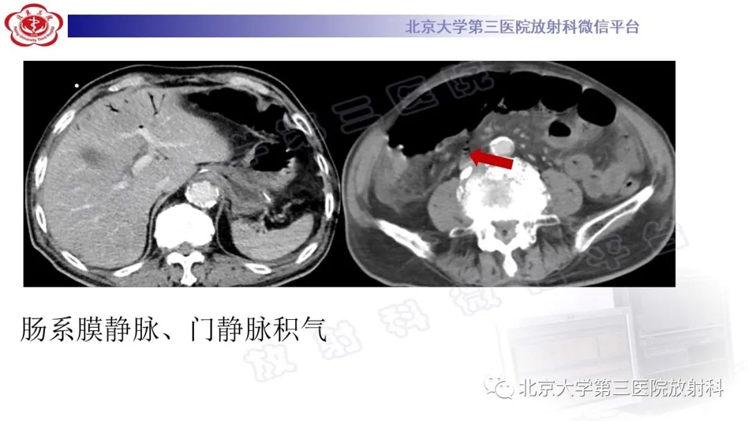 影像PPT - 【PPT】肠气囊肿症-7