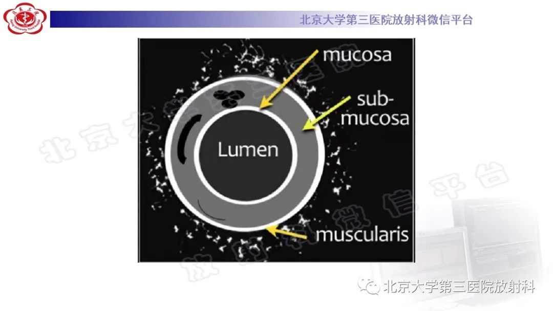 影像PPT - 【PPT】肠气囊肿症-20
