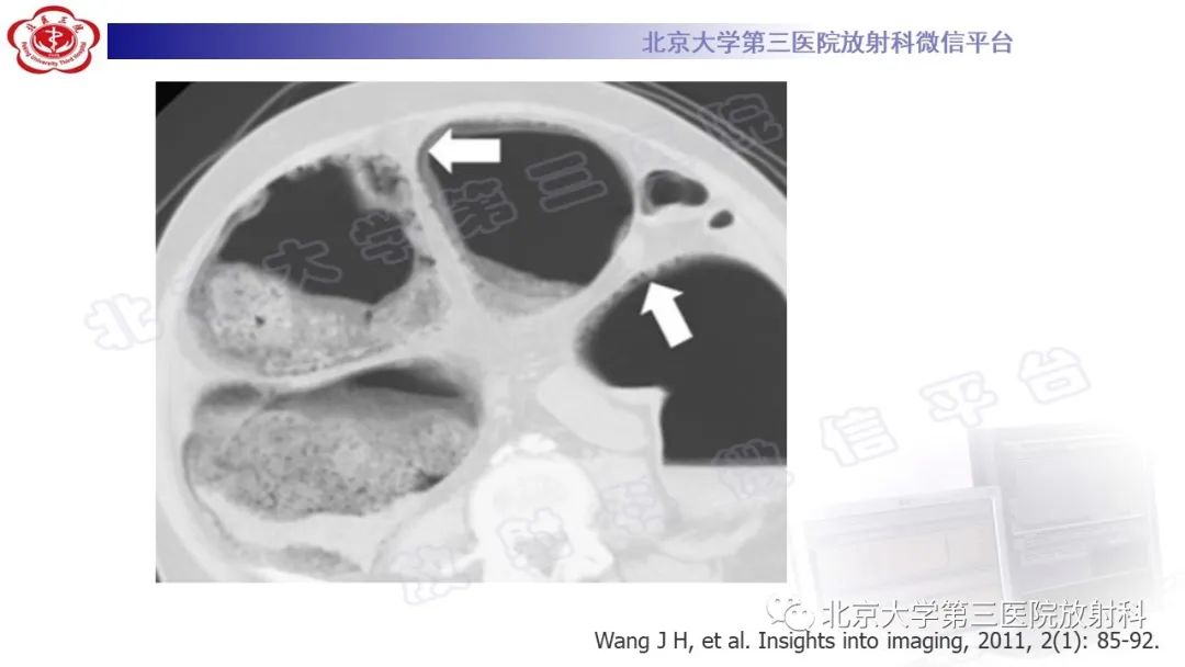 影像PPT - 【PPT】肠气囊肿症-23