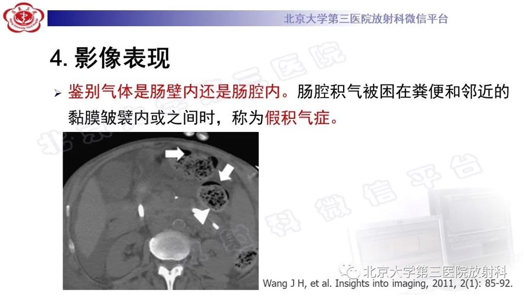 影像PPT - 【PPT】肠气囊肿症-24