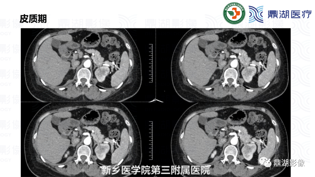 影像PPT - 【病例】肾脏血管平滑肌脂肪瘤—蛋筒冰淇淋征-7 影像PPT - 【病例】肾脏血管平滑肌脂肪瘤—蛋筒冰淇淋征-7