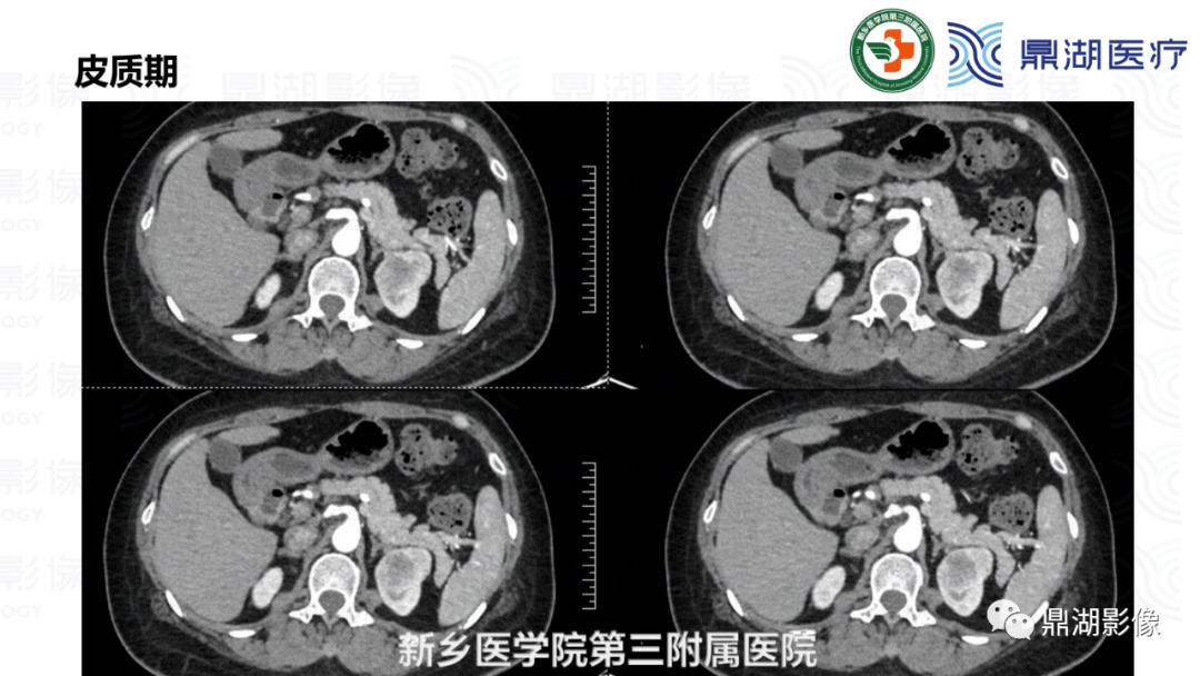 影像PPT - 【病例】肾脏血管平滑肌脂肪瘤—蛋筒冰淇淋征-8 影像PPT - 【病例】肾脏血管平滑肌脂肪瘤—蛋筒冰淇淋征-8