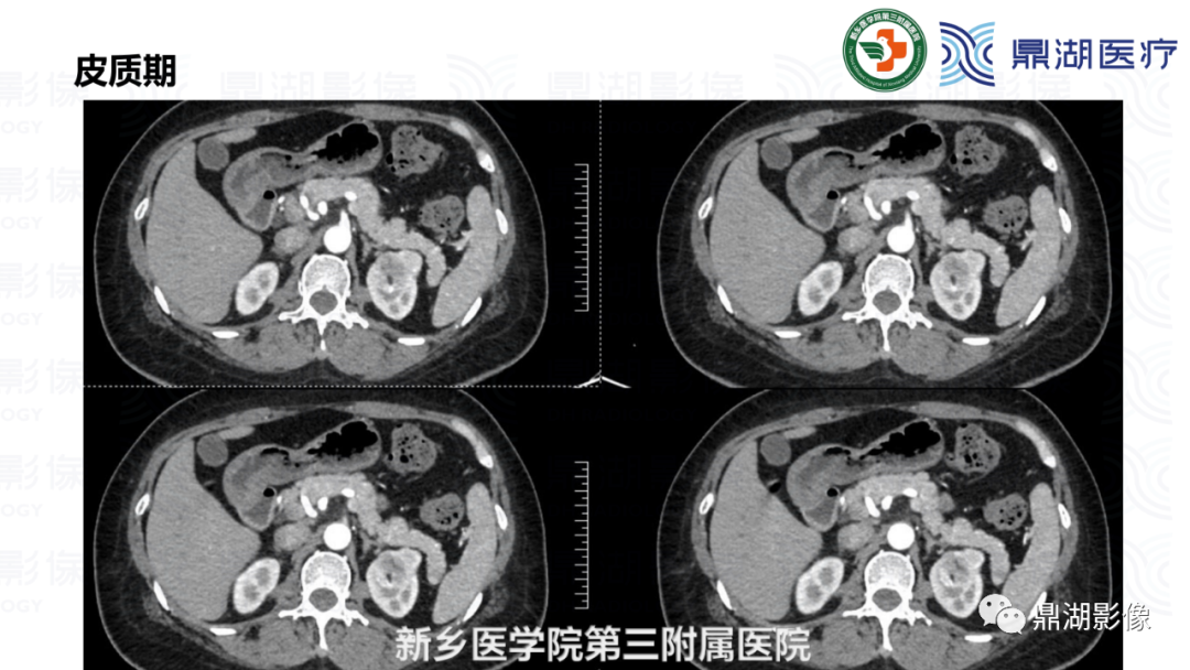 影像PPT - 【病例】肾脏血管平滑肌脂肪瘤—蛋筒冰淇淋征-9 影像PPT - 【病例】肾脏血管平滑肌脂肪瘤—蛋筒冰淇淋征-9