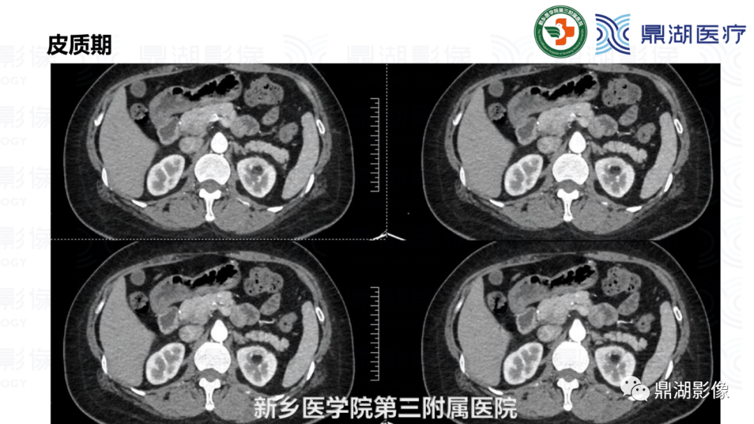 影像PPT - 【病例】肾脏血管平滑肌脂肪瘤—蛋筒冰淇淋征-10 影像PPT - 【病例】肾脏血管平滑肌脂肪瘤—蛋筒冰淇淋征-10