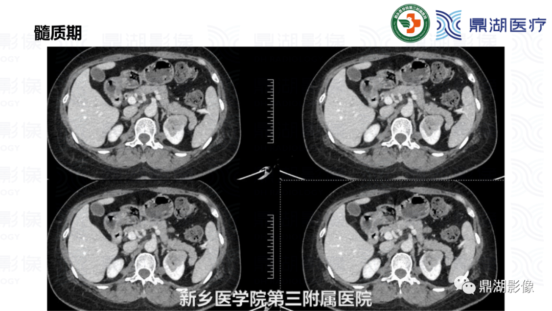 影像PPT - 【病例】肾脏血管平滑肌脂肪瘤—蛋筒冰淇淋征-12 影像PPT - 【病例】肾脏血管平滑肌脂肪瘤—蛋筒冰淇淋征-12