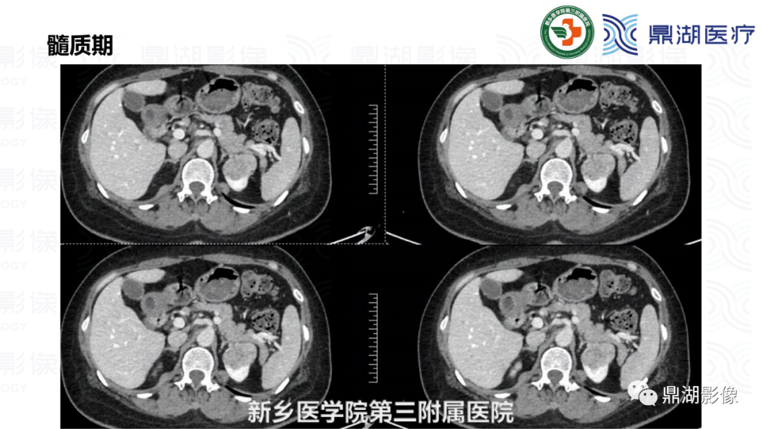 影像PPT - 【病例】肾脏血管平滑肌脂肪瘤—蛋筒冰淇淋征-11 影像PPT - 【病例】肾脏血管平滑肌脂肪瘤—蛋筒冰淇淋征-11
