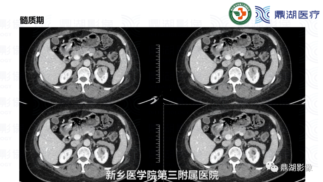 影像PPT - 【病例】肾脏血管平滑肌脂肪瘤—蛋筒冰淇淋征-13 影像PPT - 【病例】肾脏血管平滑肌脂肪瘤—蛋筒冰淇淋征-13