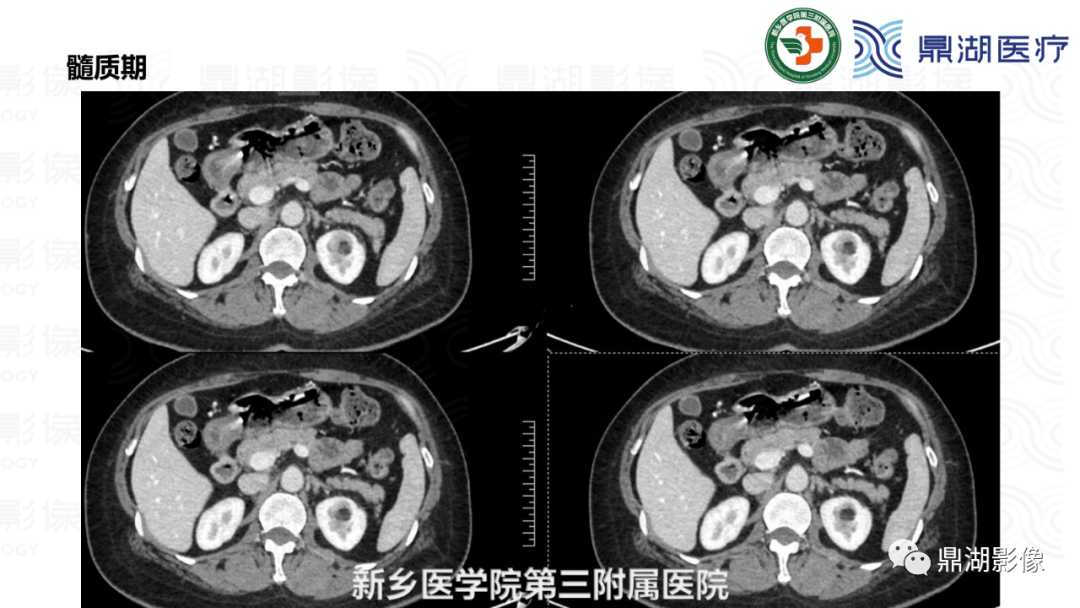 影像PPT - 【病例】肾脏血管平滑肌脂肪瘤—蛋筒冰淇淋征-14 影像PPT - 【病例】肾脏血管平滑肌脂肪瘤—蛋筒冰淇淋征-14