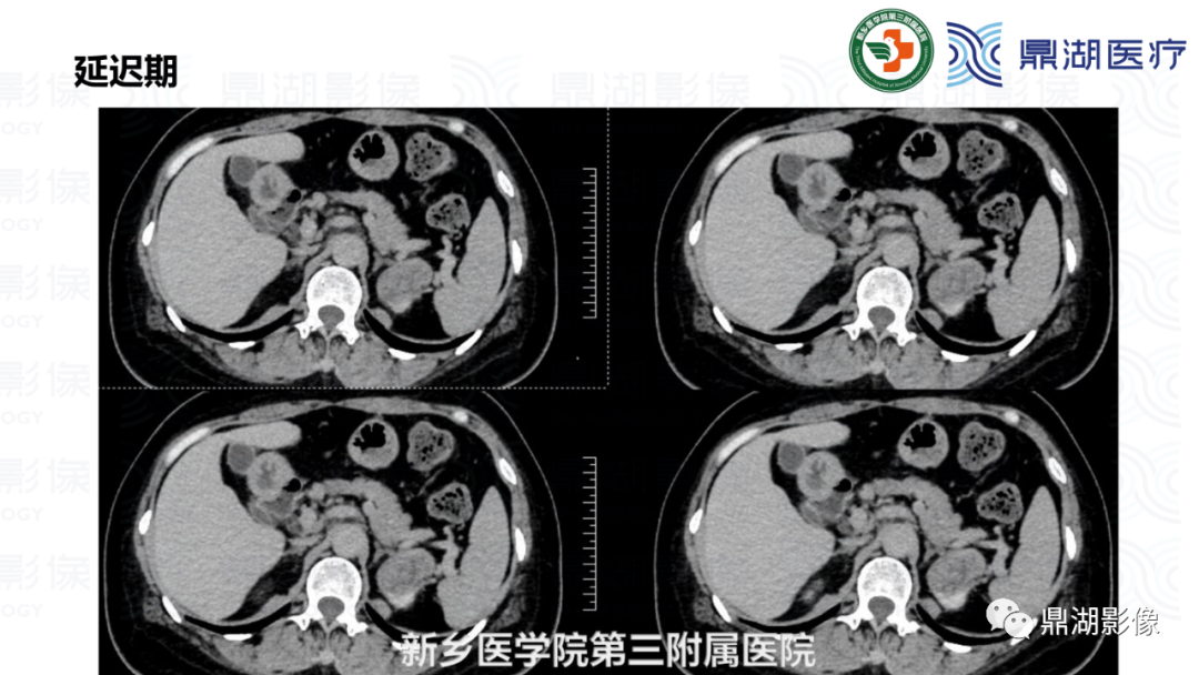 影像PPT - 【病例】肾脏血管平滑肌脂肪瘤—蛋筒冰淇淋征-15 影像PPT - 【病例】肾脏血管平滑肌脂肪瘤—蛋筒冰淇淋征-15