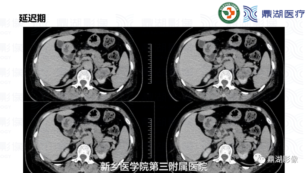 影像PPT - 【病例】肾脏血管平滑肌脂肪瘤—蛋筒冰淇淋征-16 影像PPT - 【病例】肾脏血管平滑肌脂肪瘤—蛋筒冰淇淋征-16