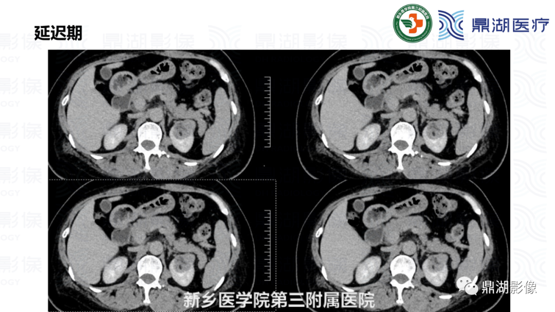 影像PPT - 【病例】肾脏血管平滑肌脂肪瘤—蛋筒冰淇淋征-17 影像PPT - 【病例】肾脏血管平滑肌脂肪瘤—蛋筒冰淇淋征-17