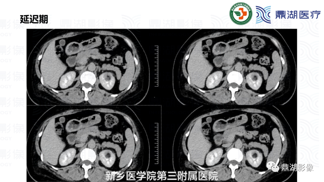 影像PPT - 【病例】肾脏血管平滑肌脂肪瘤—蛋筒冰淇淋征-18 影像PPT - 【病例】肾脏血管平滑肌脂肪瘤—蛋筒冰淇淋征-18
