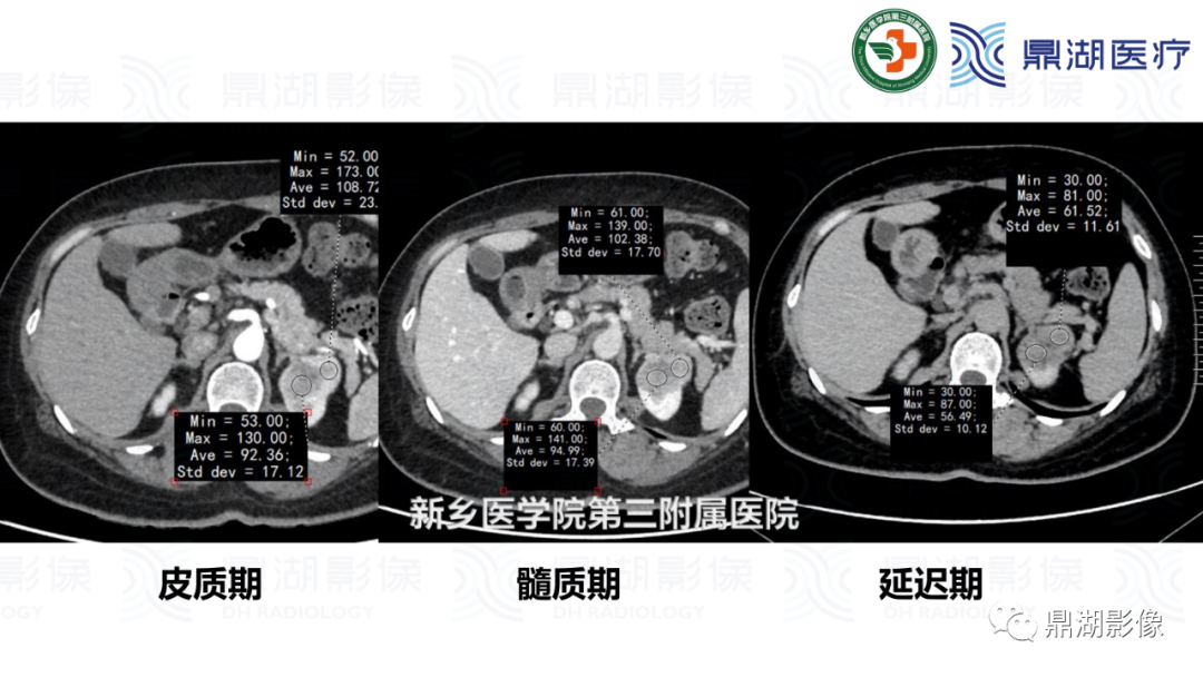 影像PPT - 【病例】肾脏血管平滑肌脂肪瘤—蛋筒冰淇淋征-19 影像PPT - 【病例】肾脏血管平滑肌脂肪瘤—蛋筒冰淇淋征-19