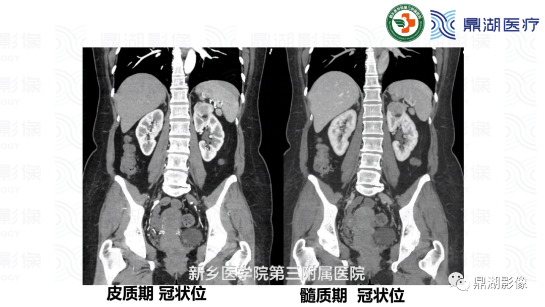 影像PPT - 【病例】肾脏血管平滑肌脂肪瘤—蛋筒冰淇淋征-20 影像PPT - 【病例】肾脏血管平滑肌脂肪瘤—蛋筒冰淇淋征-20