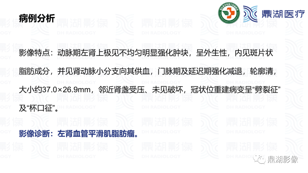 影像PPT - 【病例】肾脏血管平滑肌脂肪瘤—蛋筒冰淇淋征-23 影像PPT - 【病例】肾脏血管平滑肌脂肪瘤—蛋筒冰淇淋征-23