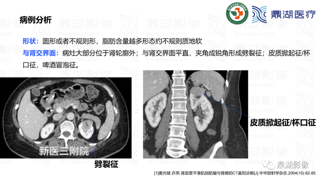 影像PPT - 【病例】肾脏血管平滑肌脂肪瘤—蛋筒冰淇淋征-24 影像PPT - 【病例】肾脏血管平滑肌脂肪瘤—蛋筒冰淇淋征-24