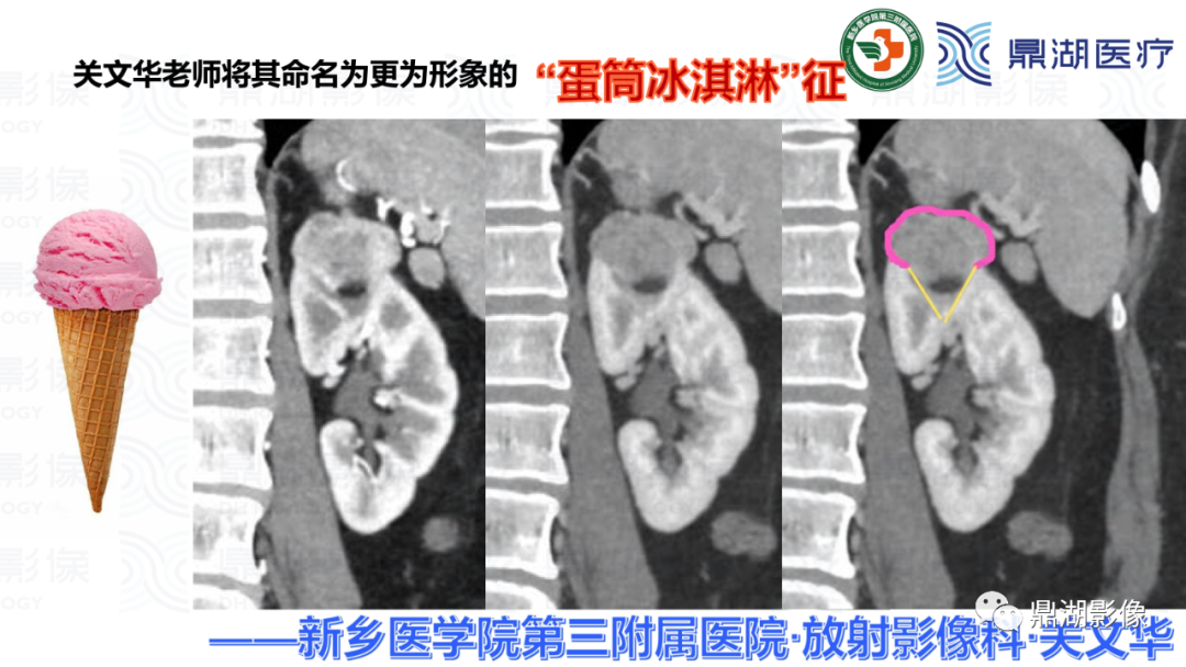 影像PPT - 【病例】肾脏血管平滑肌脂肪瘤—蛋筒冰淇淋征-25 影像PPT - 【病例】肾脏血管平滑肌脂肪瘤—蛋筒冰淇淋征-25