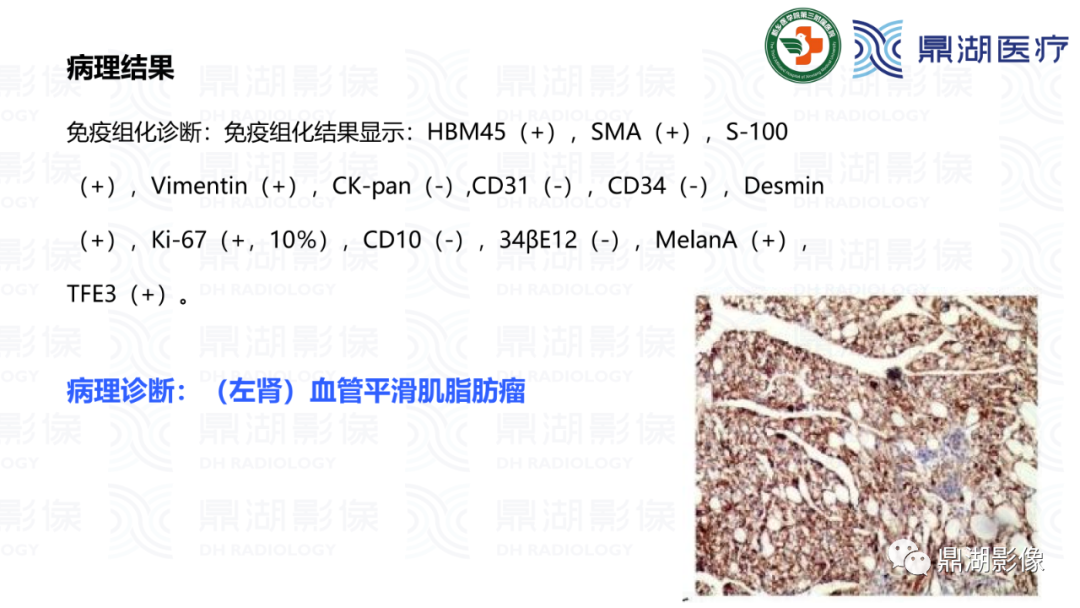 影像PPT - 【病例】肾脏血管平滑肌脂肪瘤—蛋筒冰淇淋征-26 影像PPT - 【病例】肾脏血管平滑肌脂肪瘤—蛋筒冰淇淋征-26