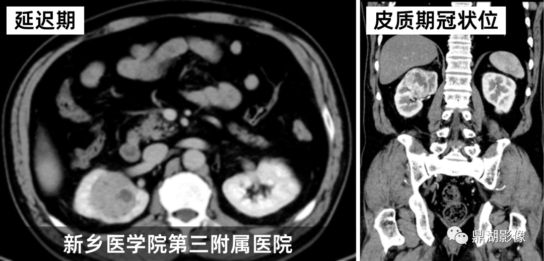 影像PPT - 【病例】肾脏血管平滑肌脂肪瘤—蛋筒冰淇淋征-29 影像PPT - 【病例】肾脏血管平滑肌脂肪瘤—蛋筒冰淇淋征-29
