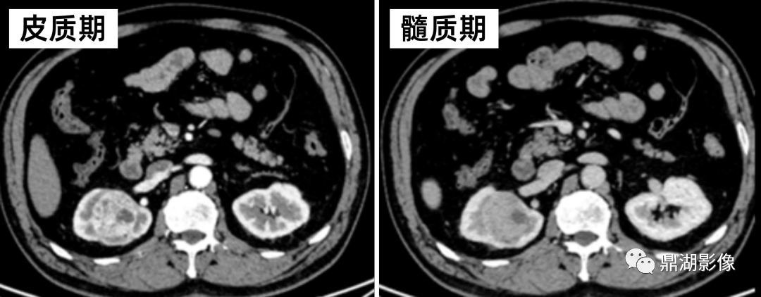 影像PPT - 【病例】肾脏血管平滑肌脂肪瘤—蛋筒冰淇淋征-28 影像PPT - 【病例】肾脏血管平滑肌脂肪瘤—蛋筒冰淇淋征-28
