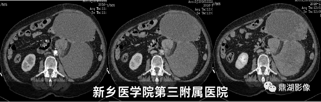影像PPT - 【病例】肾脏血管平滑肌脂肪瘤—蛋筒冰淇淋征-30 影像PPT - 【病例】肾脏血管平滑肌脂肪瘤—蛋筒冰淇淋征-30