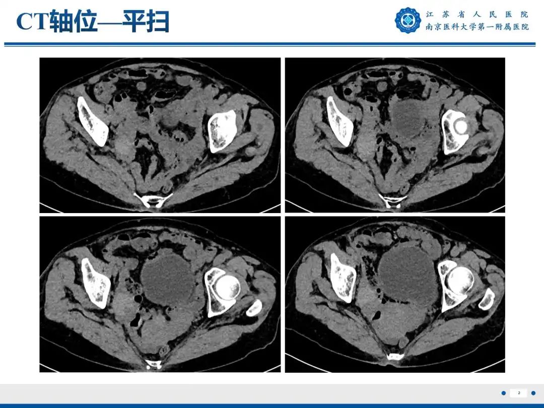 影像PPT - 【PPT】卵巢子宫内膜样癌-3