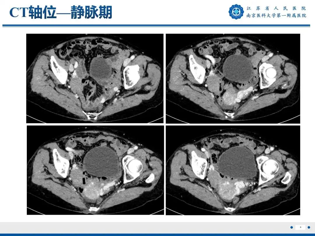 影像PPT - 【PPT】卵巢子宫内膜样癌-5
