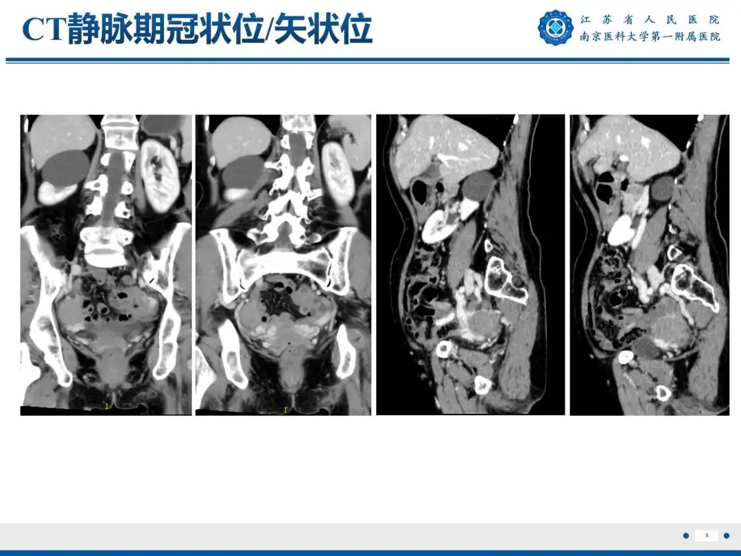 影像PPT - 【PPT】卵巢子宫内膜样癌-6
