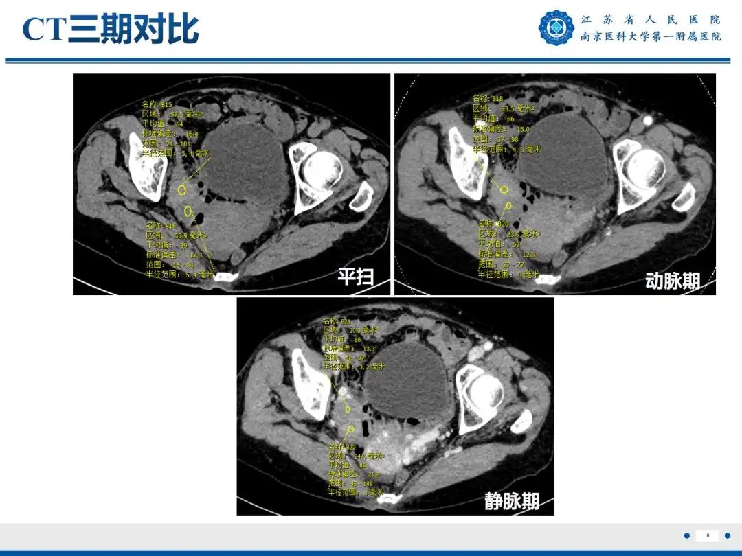 影像PPT - 【PPT】卵巢子宫内膜样癌-7