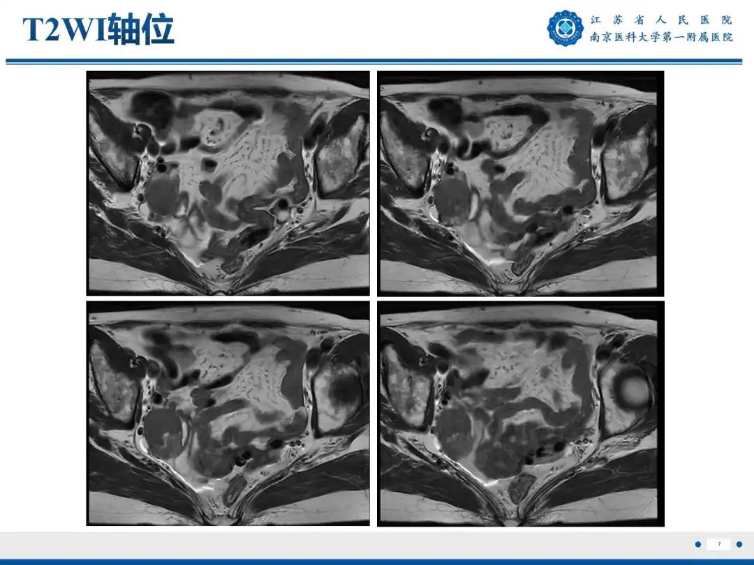 影像PPT - 【PPT】卵巢子宫内膜样癌-8