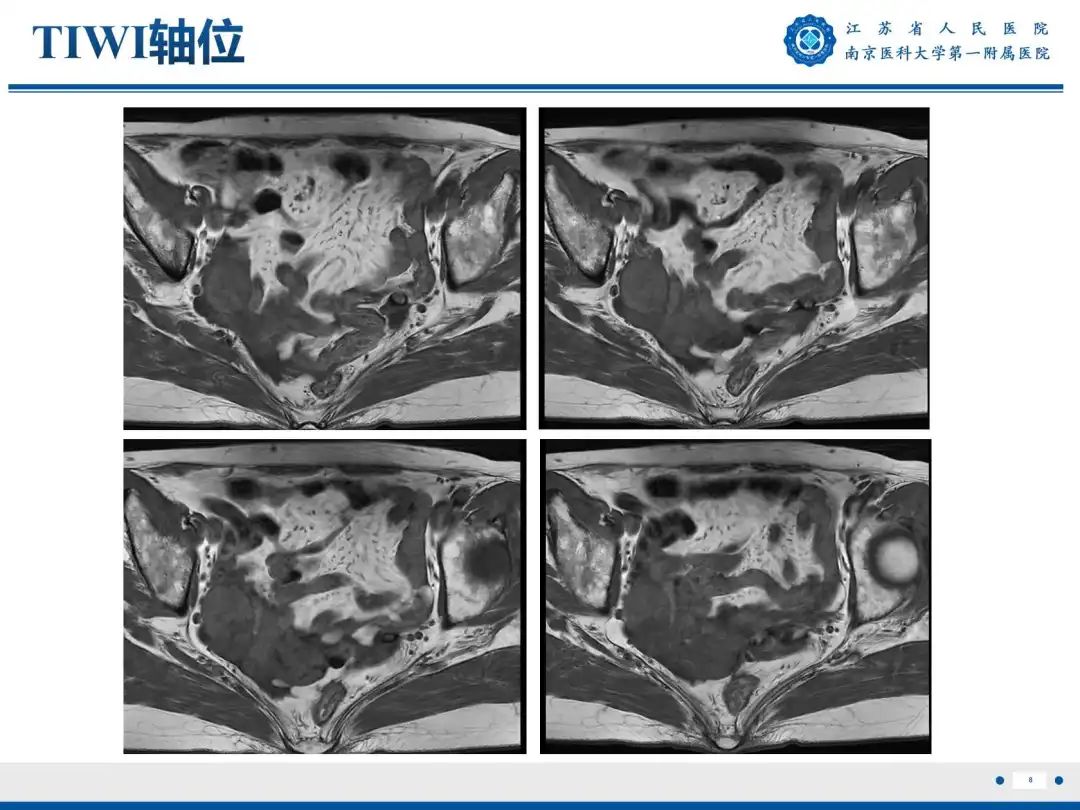 影像PPT - 【PPT】卵巢子宫内膜样癌-9