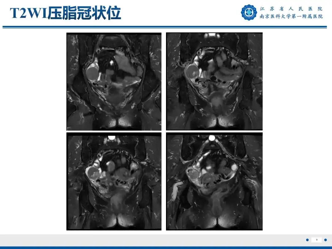 影像PPT - 【PPT】卵巢子宫内膜样癌-10