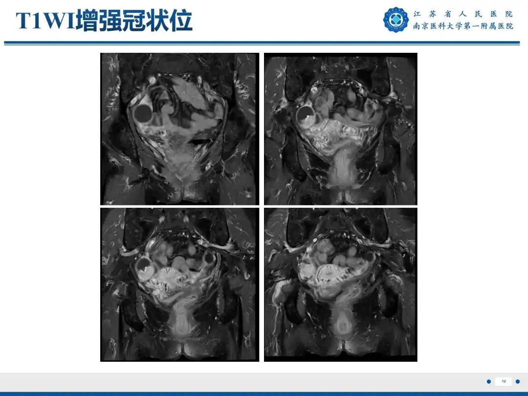 影像PPT - 【PPT】卵巢子宫内膜样癌-13