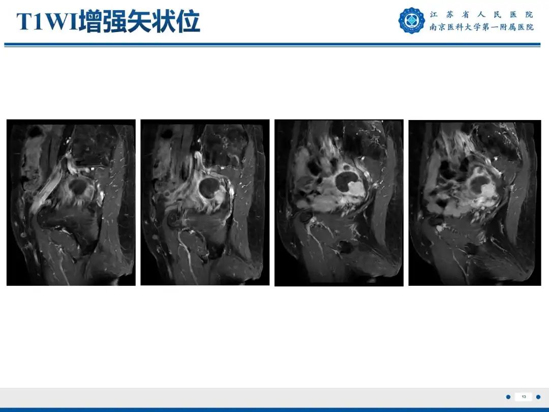 影像PPT - 【PPT】卵巢子宫内膜样癌-14