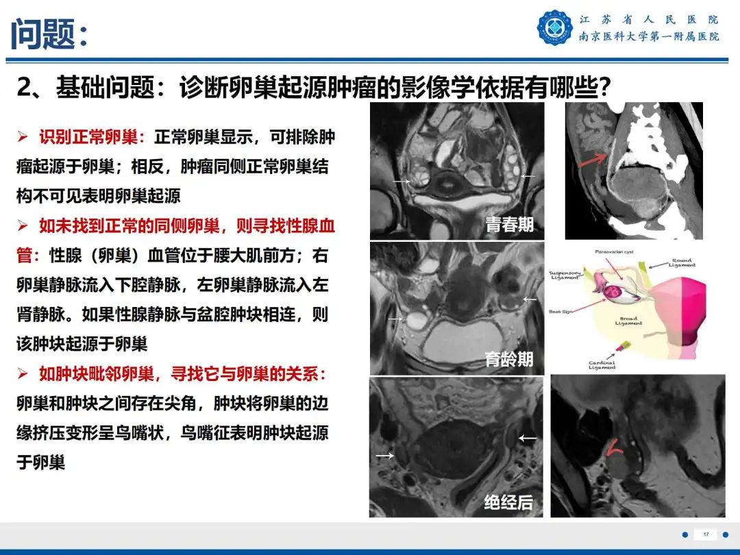 影像PPT - 【PPT】卵巢子宫内膜样癌-18