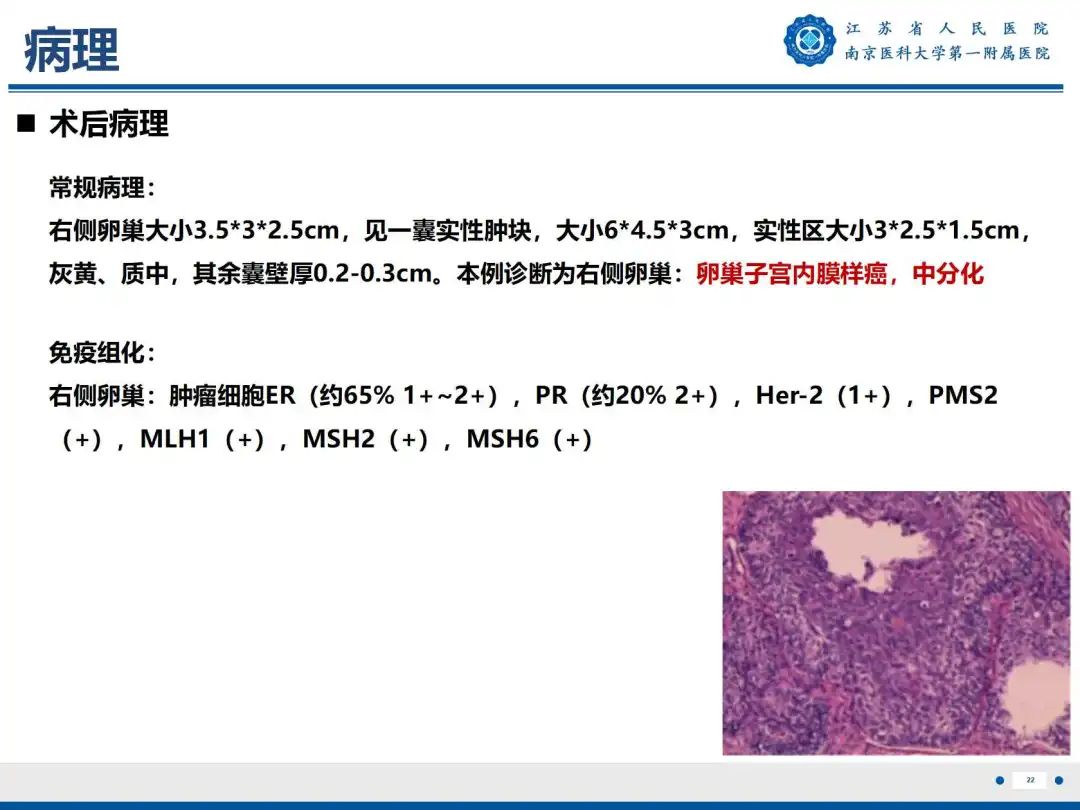 影像PPT - 【PPT】卵巢子宫内膜样癌-23