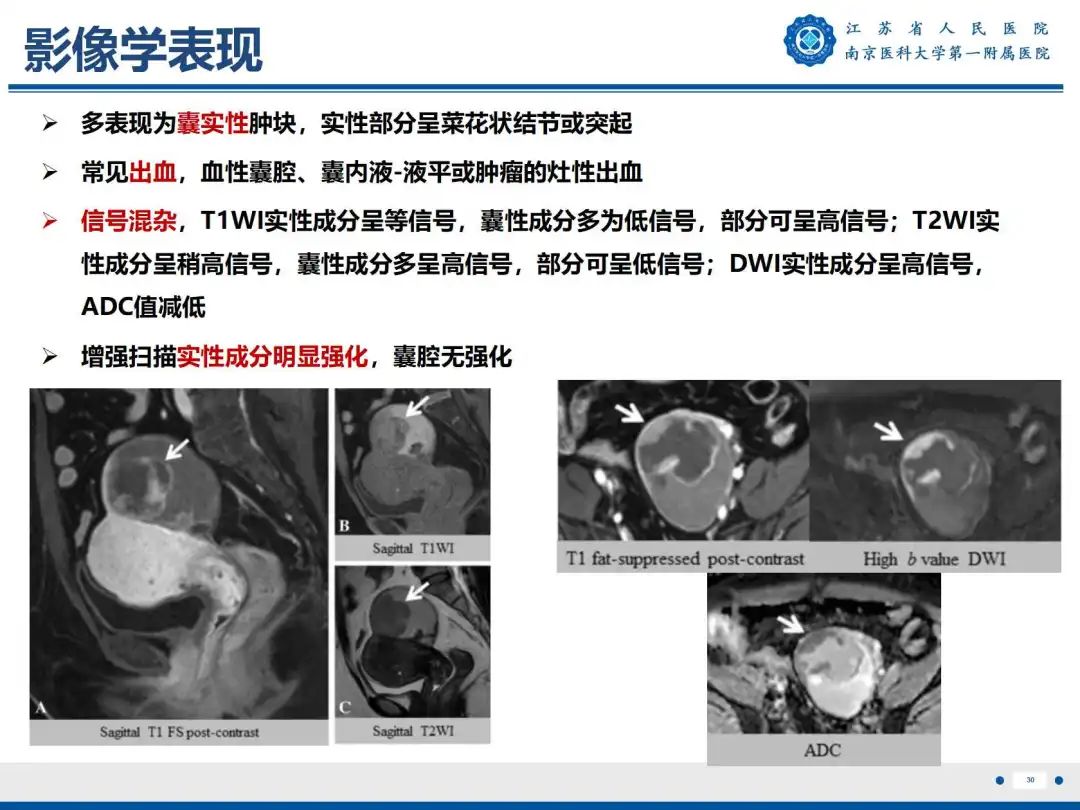 影像PPT - 【PPT】卵巢子宫内膜样癌-31