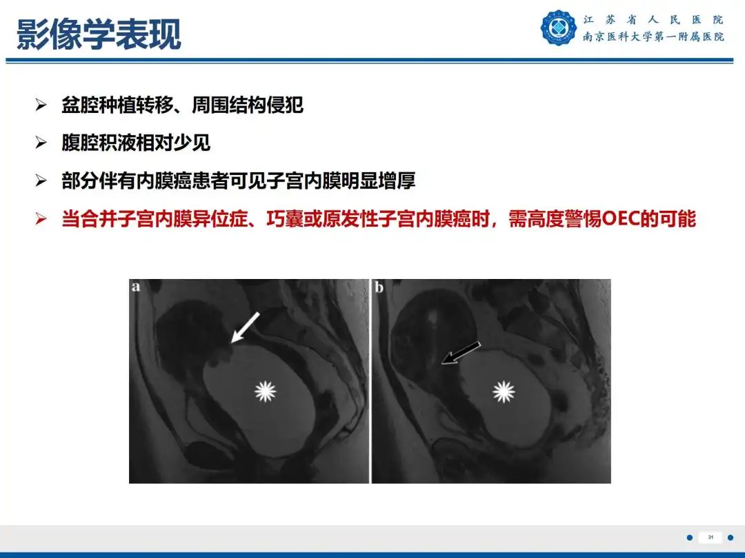 影像PPT - 【PPT】卵巢子宫内膜样癌-32