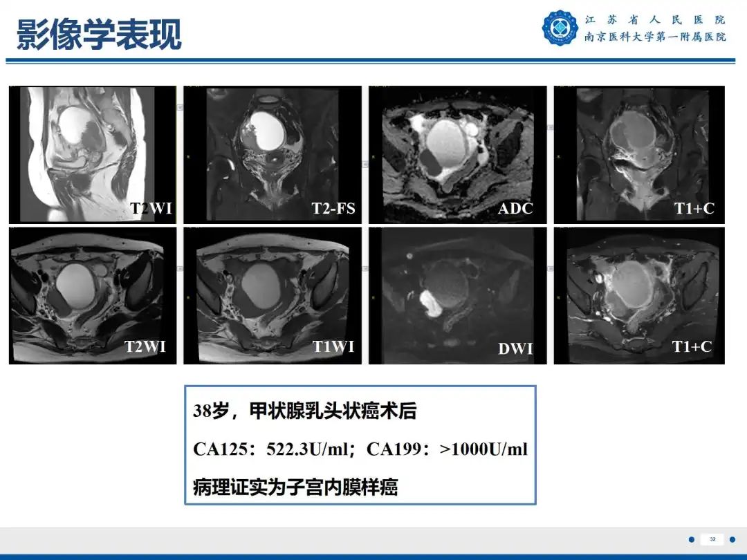 影像PPT - 【PPT】卵巢子宫内膜样癌-33