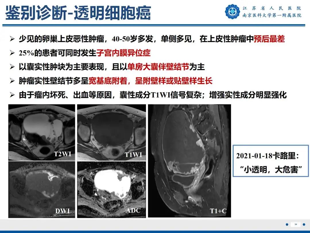 影像PPT - 【PPT】卵巢子宫内膜样癌-35