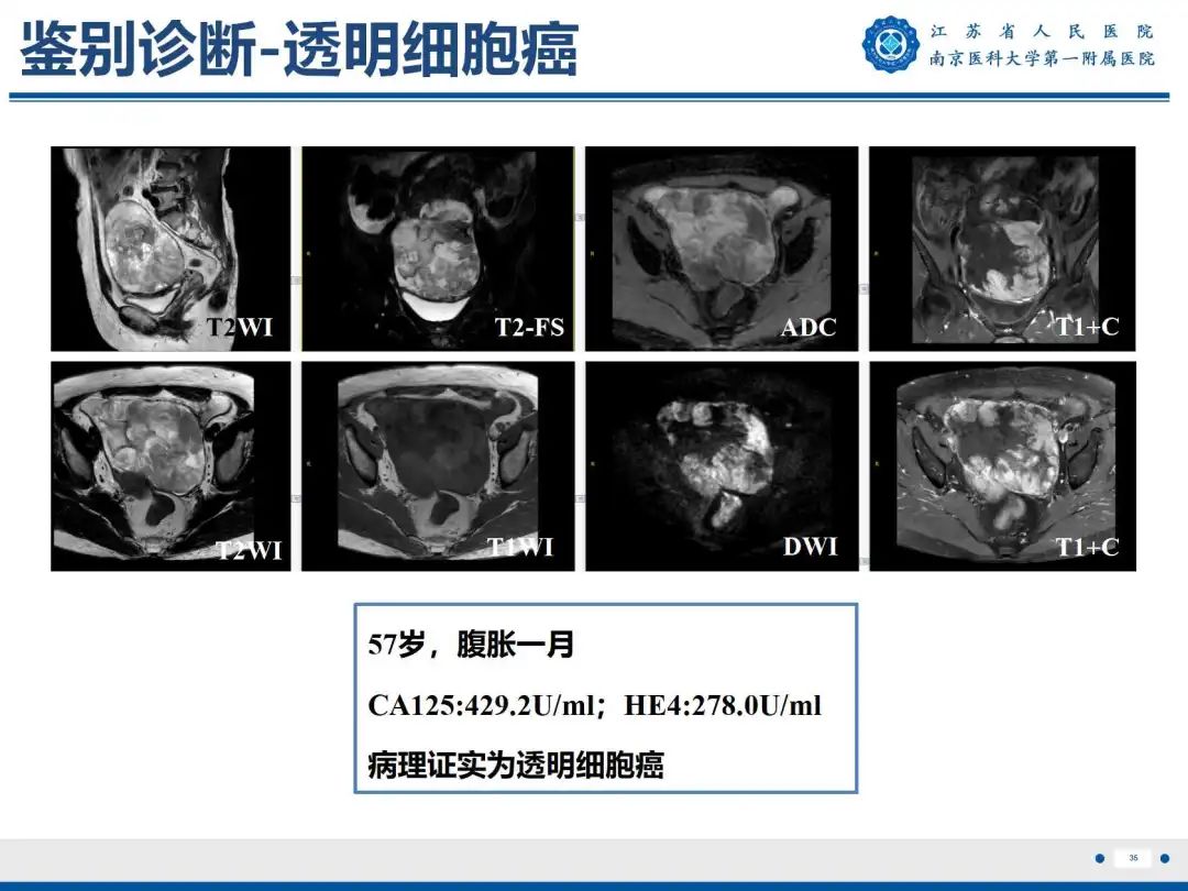 影像PPT - 【PPT】卵巢子宫内膜样癌-36