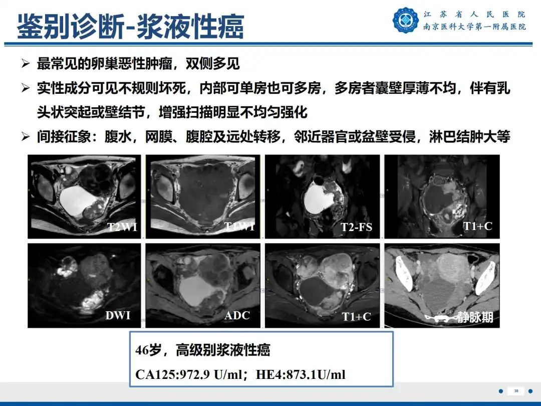 影像PPT - 【PPT】卵巢子宫内膜样癌-39