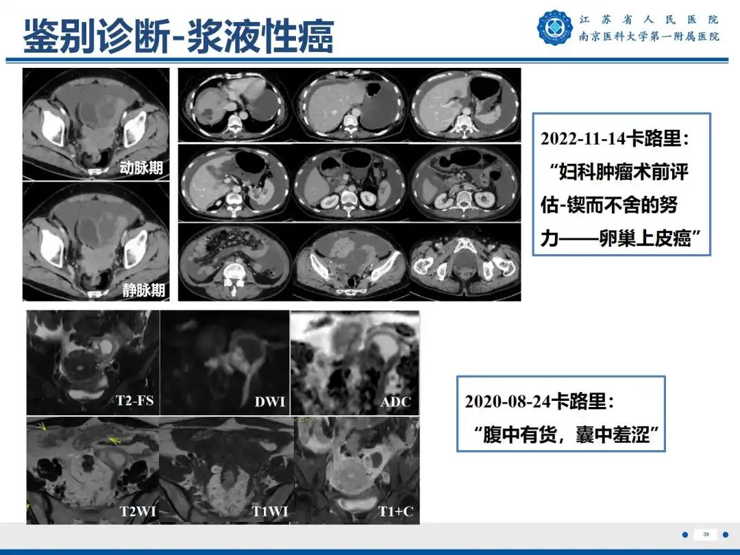 影像PPT - 【PPT】卵巢子宫内膜样癌-40