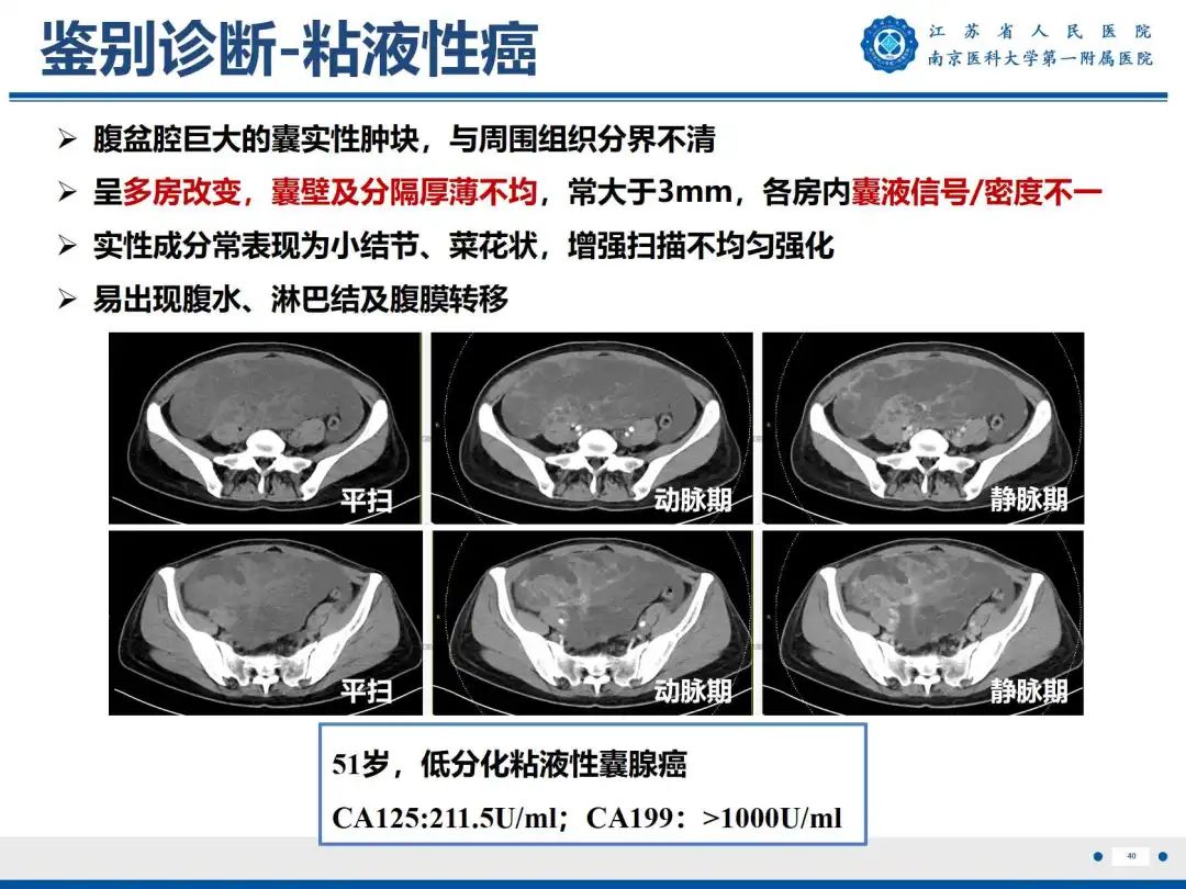 影像PPT - 【PPT】卵巢子宫内膜样癌-41