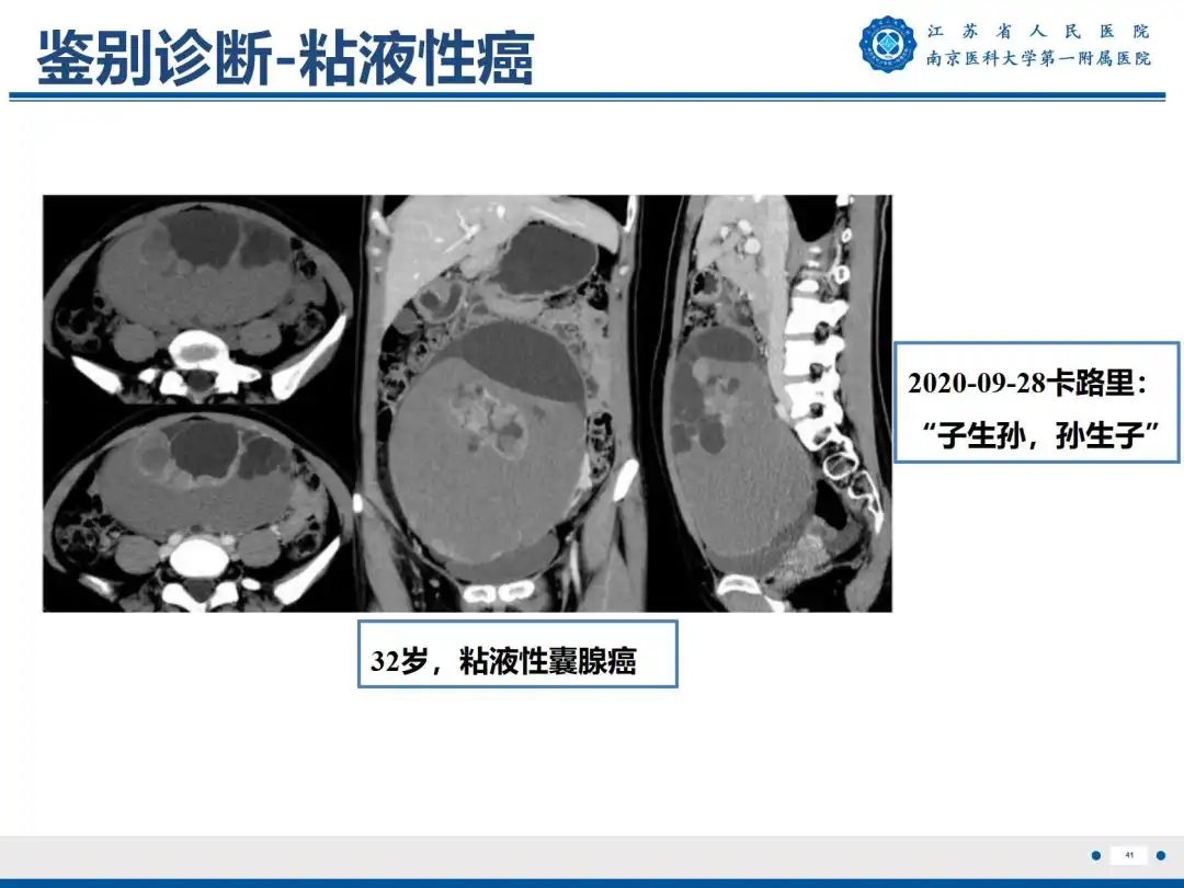 影像PPT - 【PPT】卵巢子宫内膜样癌-42