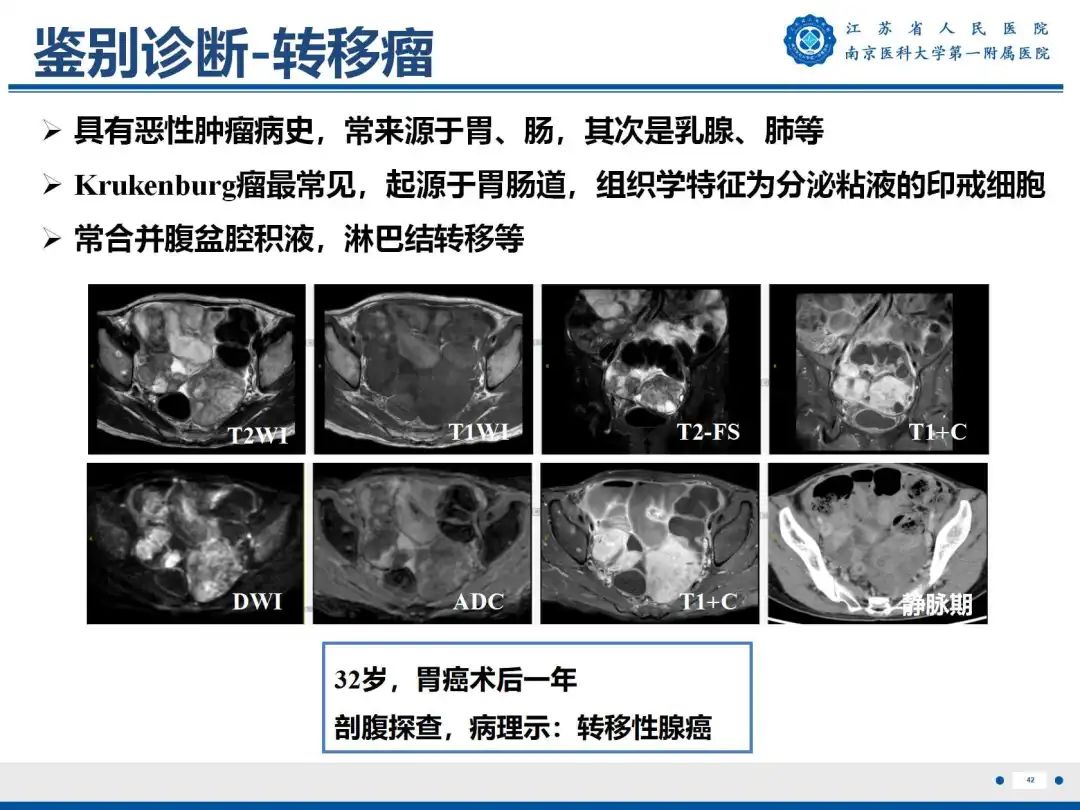 影像PPT - 【PPT】卵巢子宫内膜样癌-43
