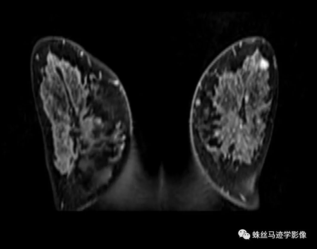 影像PPT - 【病例】乳腺放射状瘢痕1例MR影像-5 影像PPT - 【病例】乳腺放射状瘢痕1例MR影像-5