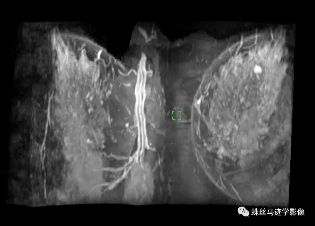 影像PPT - 【病例】乳腺放射状瘢痕1例MR影像-6 影像PPT - 【病例】乳腺放射状瘢痕1例MR影像-6