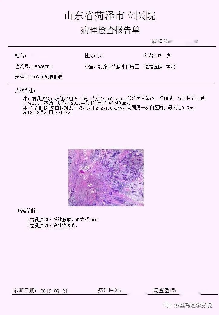 影像PPT - 【病例】乳腺放射状瘢痕1例MR影像-7 影像PPT - 【病例】乳腺放射状瘢痕1例MR影像-7