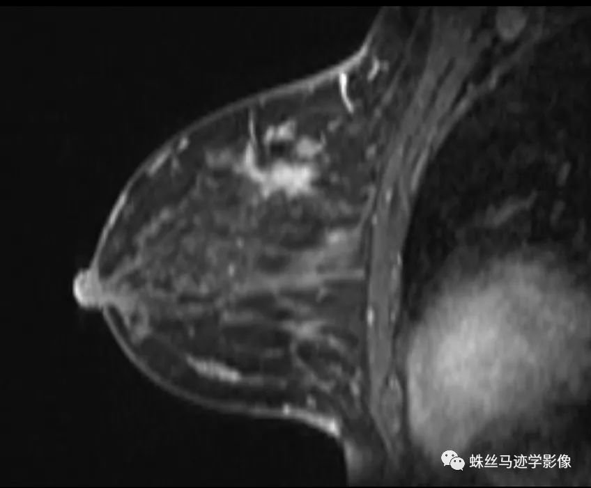 影像PPT - 【病例】乳腺放射状瘢痕1例MR影像-9 影像PPT - 【病例】乳腺放射状瘢痕1例MR影像-9